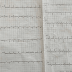 A 76-Year-Old Man With Hemorrhagic Stroke, Recurrent Thromboembolic Events, and Atrial Fibrillation Under Optimal Medical Treatment: When Anticoagulants Fail - Cureus