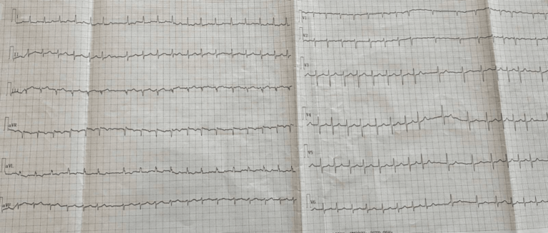 A 76-Year-Old Man With Hemorrhagic Stroke, Recurrent Thromboembolic Events, and Atrial Fibrillation Under Optimal Medical Treatment: When Anticoagulants Fail - Cureus