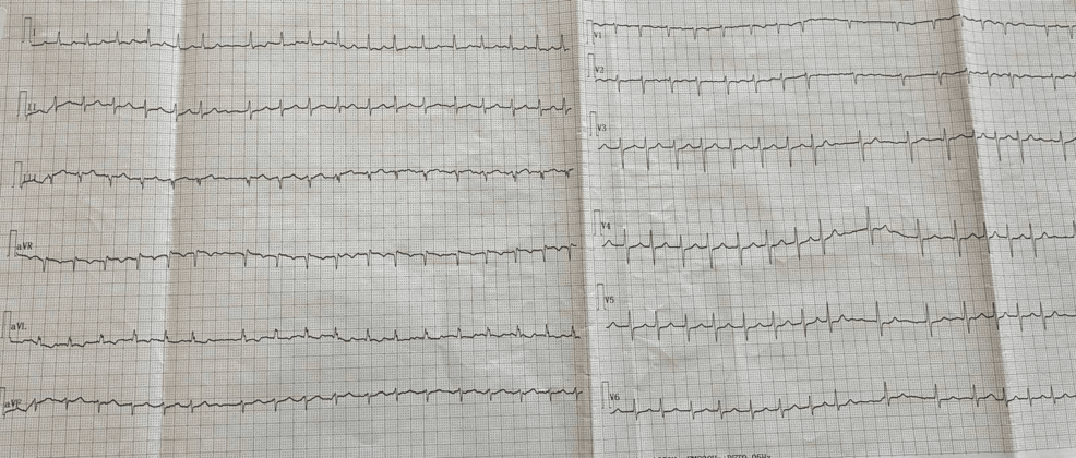A 76-Year-Old Man With Hemorrhagic Stroke, Recurrent Thromboembolic Events, and Atrial Fibrillation Under Optimal Medical Treatment: When Anticoagulants Fail - Cureus