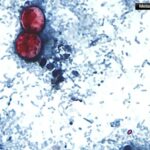 Cyclospora on the rise in New York: What to know about parasite causing severe stomach sickness - News12 | Long Island