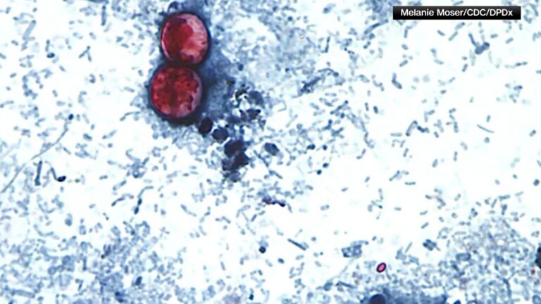 Cyclospora on the rise in New York: What to know about parasite causing severe stomach sickness - News12 | Long Island