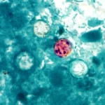 CDC warns of rising parasite infections with a horrifying symptom: 2026 cyclosporiasis outbreak spreads - Fast Company