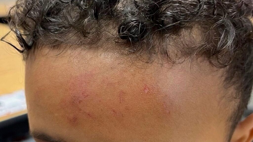 Visalia parents seek cameras in special ed rooms after unexplained injuries - kmph.com
