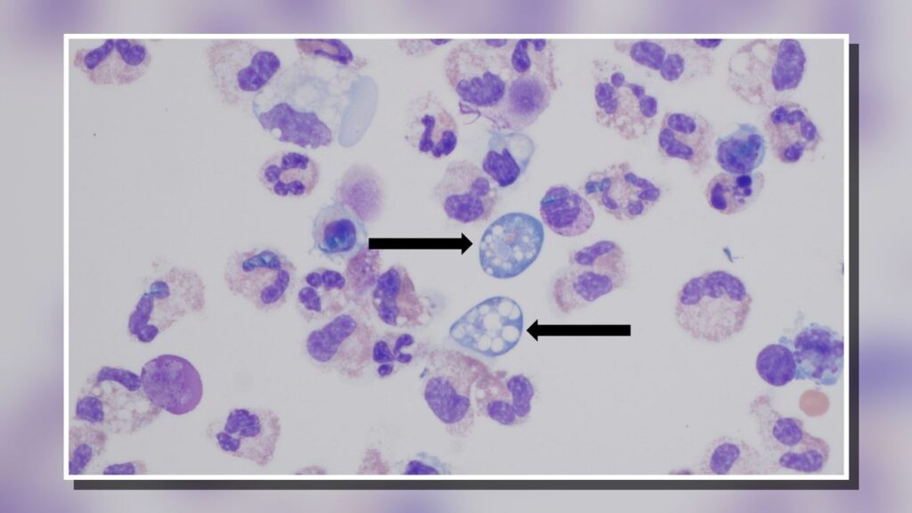 Central North Carolina teen critically ill with rare brain eating amoeba infection - WCTI