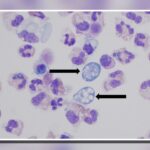Central North Carolina teen critically ill with rare brain eating amoeba infection - WCTI