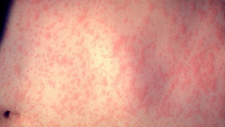 VOTE: Are you concerned about the measles cases in Kern County? - KBAK