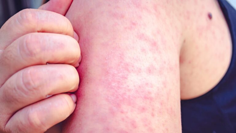 New measles cases in Ohio slow as Pennsylvania reports two deaths - The Marion Star