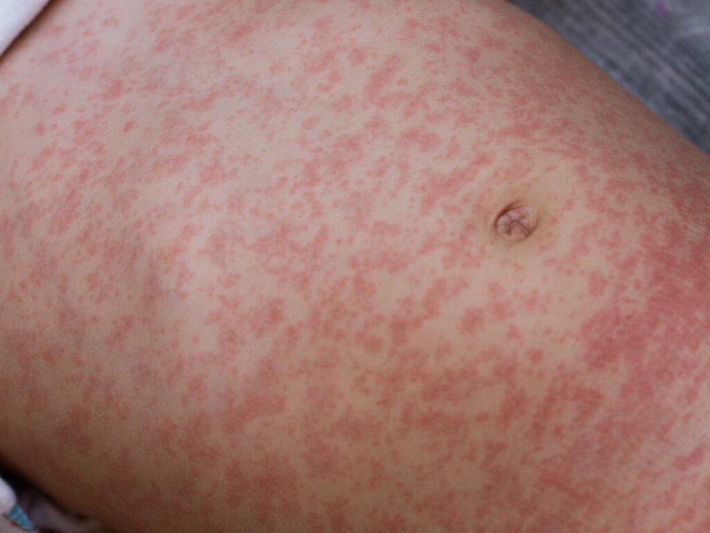 Measles Case Surfaces In Pittsburgh - Patch