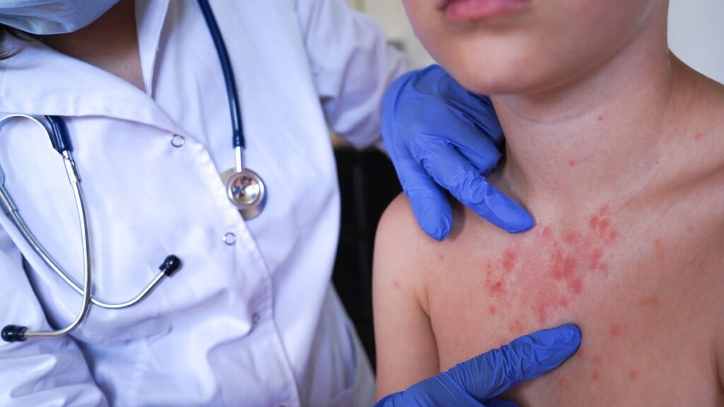 Measles outbreak confirmed in Illinois. Here's what to know - Peoria Journal Star