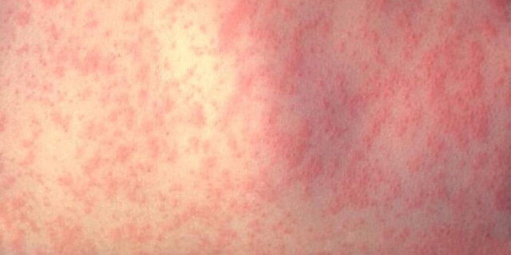 Experts share precautions as measles cases rise in Missouri - KY3