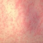 Experts share precautions as measles cases rise in Missouri - KY3