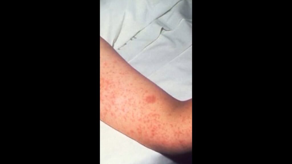 Third person dies in Pennsylvania measles outbreak - Modern Ghana