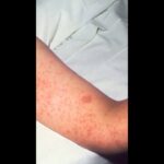 Third person dies in Pennsylvania measles outbreak - Modern Ghana