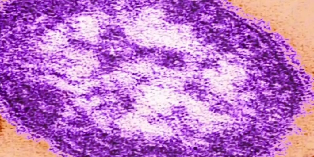 State health leaders sound alarm over high cases of measles in Laurel County - WKYT