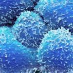 How has the treatment of low-risk prostate cancer evolved in the US? - Oncology Central