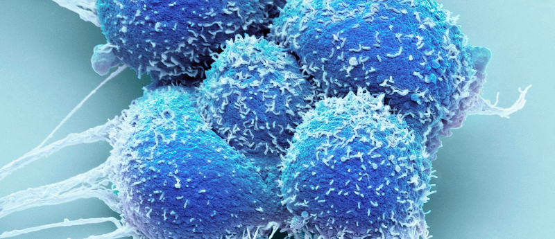 How has the treatment of low-risk prostate cancer evolved in the US? - Oncology Central