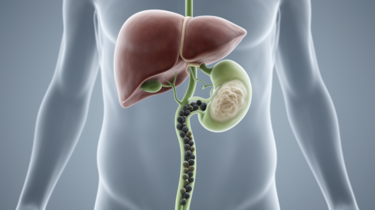 Hidden Bile Duct Tumor Masquerades as Gallstones in Landmark Case Report - Bioengineer.org