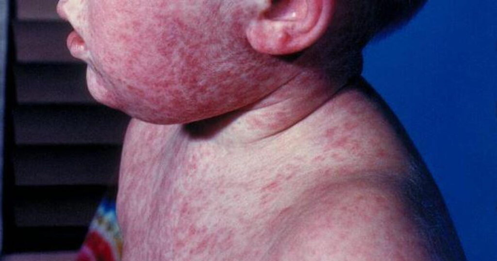 Kentucky measles cases rise to 174; hospitalizations increase to 10 - LEX 18 News